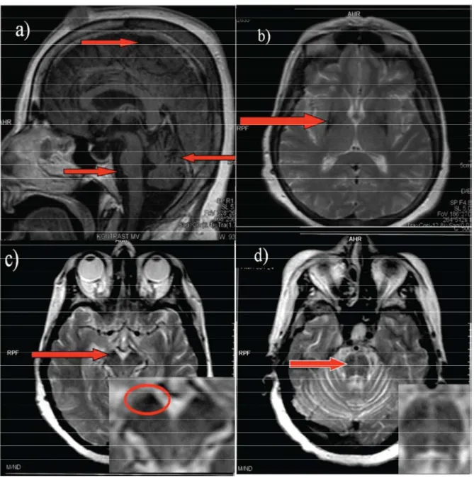 Şekil 2.2 Multisistem Atrofili bir hastaya ait Beyin MR görüntüleri: a) Beyin sapı, serebellar  atrofi ve serebral atrofi, b) Putaminal demir birikimi, c) Substantia nigrada demir birikimi, d)  Beyin sapında aksiyel kesitlerde haç işareti.(Parkinsonism and