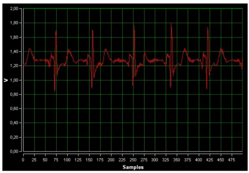 Şekil 9. Bilgisayarda görüntülenen EKG sinyalleri 