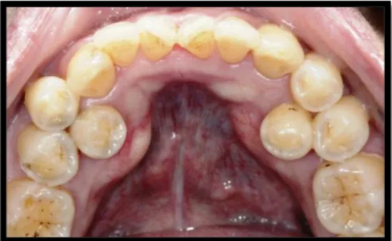 Şekil  1.2.  Hiperdonti  olgusu  (Oxford  Orthodontic Centre 2014). 