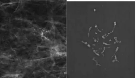 Şekil 3. Mamografide lineer dağılım gösteren pleomorfik mikrokalsifikasyonlar ve  spesmen görüntüleri BI-RADS 4B kabuledilen olgunun patoloji sonucu: duktal  karsinoma in situ 