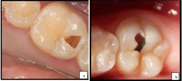 Şekil 1.3: Dentin çürüğü  Arayüz Çürüğü 