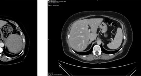 Şekil 4.2.  Abdomen segmentasyonu önünde engel teşkil eden birincil dezavantajlar 