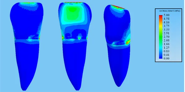 Şekil 3.11. 0°’lik kuvvet altında diş dokularındaki stres dağılımları