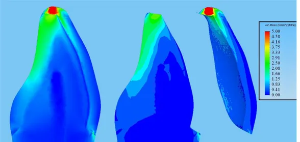 Şekil  3.21.  0°’lik  kuvvet  altında  koronal  kısmın  sagittal  kesitindeki  stres dağılımları