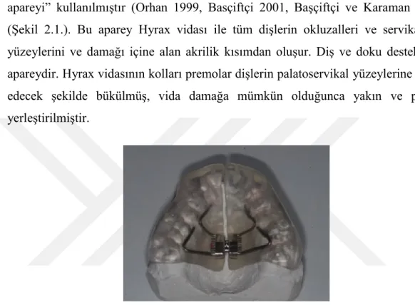 Şekil 2.1. Modifiye akrilik full bonded HÜÇG apareyi 