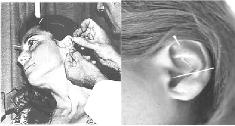 Şekil 2.3 Kulak Akupunkturu (Aurikulotherapie) uygulaması 