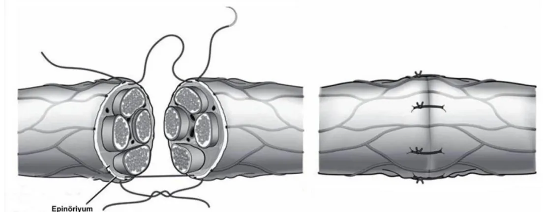 Şekil 9: Epinöral sinir onarımı (Siemionow M, Brzezicki G. Current techniques and  concepts in peripheral nerve repair