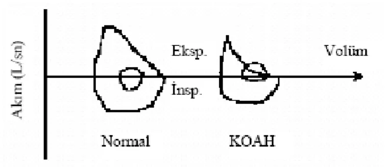 Şekil 2. KOAH’da akım volüm halkasının ekspirasyon kısmının akım hızı sınırlanması  nedeniyle iç bükey hale gelmesi