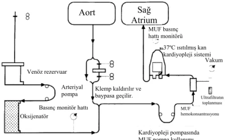 Şekil 7. Şematik Modifiye Ultrafiltrasyon  (MUF).(Darling E,Nanry K,Shearer I,et al.Techniques of  paediatric modified ultrafiltration :1996 survey results.Perfusion 1998;13:93-103) 