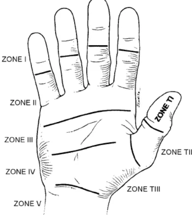 Şekil 6. Elde fleksör tendon yaralanmaları zonları (5). 