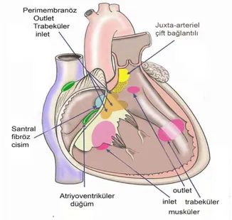 Şekil 3: Anatomik yerleşimine VSD tipleri 