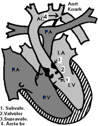 Şekil 9: Aort darlığı tipleri ve aort koarktasyonu  