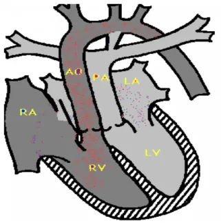 Şekil 7: Patent foramen ovale ve küçük PDA dışında önemli şant bulunmayan basit tip transpozisyon (15) 