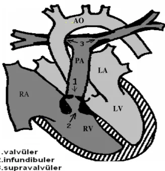 Şekil 10: Pulmoner darlığın tipleri ve anatomisi (15) 