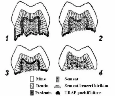 Şekil 1.1. Eksfoliye olmaya yakın süt dişlerinde rezorpsiyon süreçleri. Tartrata  dayanıklı  asit  fosfataz  (Tartrate-Resistant  Acid  Phosphatase,  TRAP)  enzimi  odontoklastların  ve  öncüllerinin  histokimyasal  olarak  teşhis  edilebilmesi  için  kull