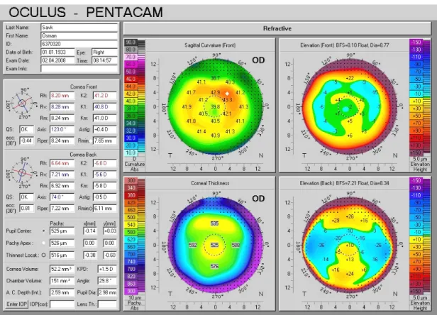 Şekil 1: Pentacam cihazının refraktif harita çıktısı