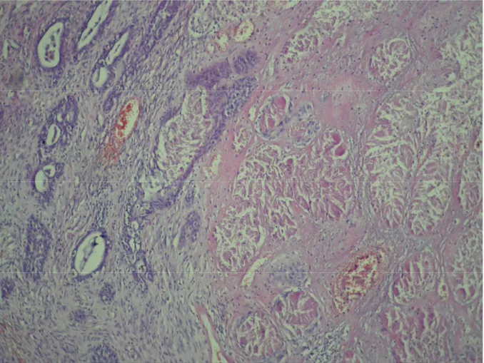 Şekil 6. Aynı hastanın patolojik preperatının sol tarafında sağlam prostat dokusu ve bezleri ile sağ tarafında nekroze alan görülmektedir