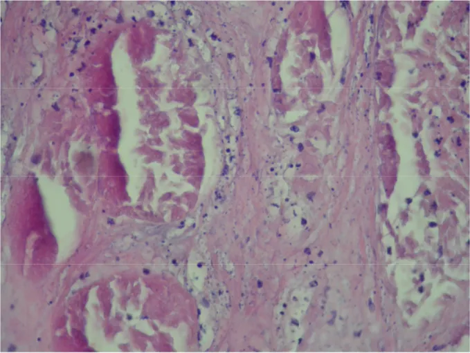 Şekil 7. Aynı hastanın patolojik preperatında prostatdaki nekroze alanın görüntüsü (HEX100)
