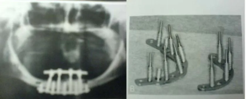Şekil 3: Transmandibular dental implant (Fonseca , Davis 1995) 