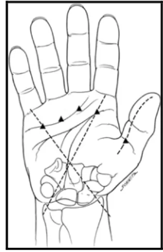 Şekil 17: Tetik parmak gevşetmede kritik noktalar  