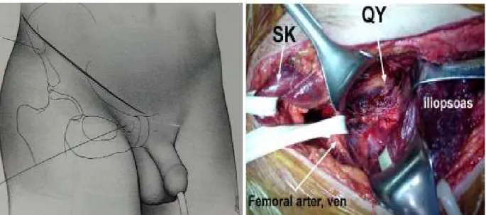 Şekil 8: İlioinguinal yaklaşım 