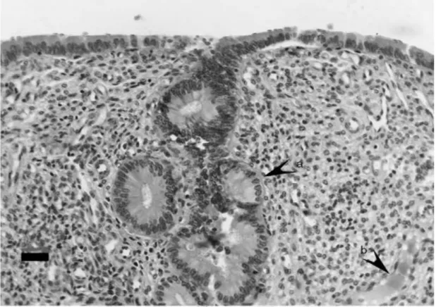 Şekil 1.7. Yangılı endometriyal doku ve nötrofil lökosit infiltrasyonu (Sheldon ve ark 2006)