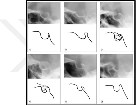 Şekil  1.6.  Sella  Turcica  varyasyonları:  (a)  normal  sella  turcica,  (b)  oblik  anterior  duvar, (c) çift konturlu sella, (d) sella turcica köprüsü, (e) düzensiz dorsum sella, (f)  piramit Ģekilli dorsum sella (Axelsson ve ark 2004)