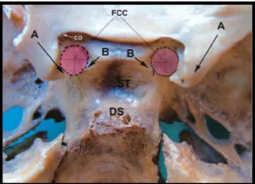 Şekil  1.18.  Ġnkomplet  tip  foramen  caroticoclinoidale;  FCC:  foramen  caroticoclinoidale,  DS:  dorsum  sellae;  ST:  sella  turcica;  CO:  canalis  opticus;  A: 