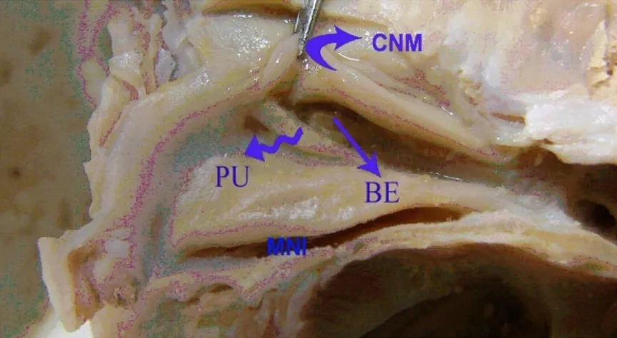 Şekil 1.17. 28 haftalık dişi fetusta sağ CN’de CNM’nin kaldırılması ile gözlenen  oluşumlar