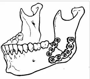 Şekil 2.7 AO/ASIF  metoduna göre inferior  mandibular kenara bikortikal vidalar ile  kompresyon plağı  yerleştirilirken, superior kenara ise monokortikal vidalar ile gerilim miniplağı yerleştirilir