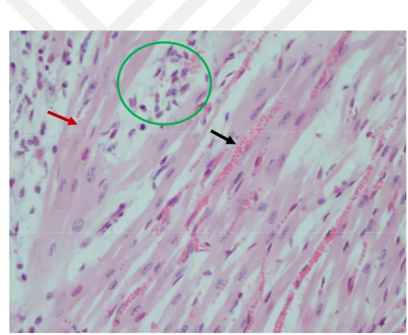 Şekil  3.7.  Lenfohistiyositer  miyokarditis.  Damarlarda  hiperemi  (siyah  ok),  miyositlerde  hiyalin dejenerasyonu (kırmızı ok), MNH infiltrasyonu (çember)