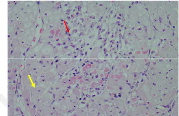 Şekil 3.9. Lenfohistiyositer miyokarditis. Yaygın MNH infiltrasyonları (sarı ok) ve  miyositlerde nekroz (kırmızı ok)