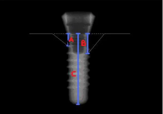 Şekil 2.1. Panoramik radyograflarda kemik kaybı miktarı hesaplanması için şekilde belirtilen hatlarda  ölçüm yapıldı