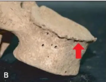 Şekil 1.16. Grade 1: Corpus vertebra’dan yükselen tek bir osteofit noktası (Kim ve ark 2012).