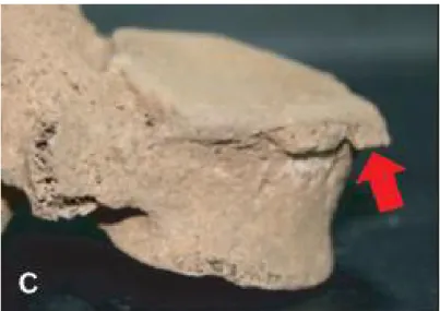Şekil 1.17. Grade 2: Horizontal olarak seyreden osteofit çıkıntıları (Kim ve ark 2012)