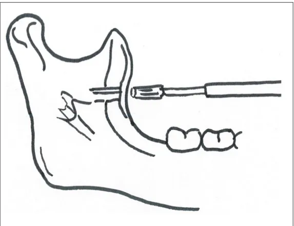 Şekil 1.8. Lingulanın hemen üzerinden ramusun yarısına kadar yapılan oblik  osteotomi 