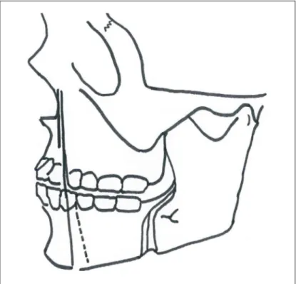 Şekil  1.12.  Piriform  rimden  geçerek  premolar-molar  bölgeye bağlanan tellerle yapılan fiksasyon  