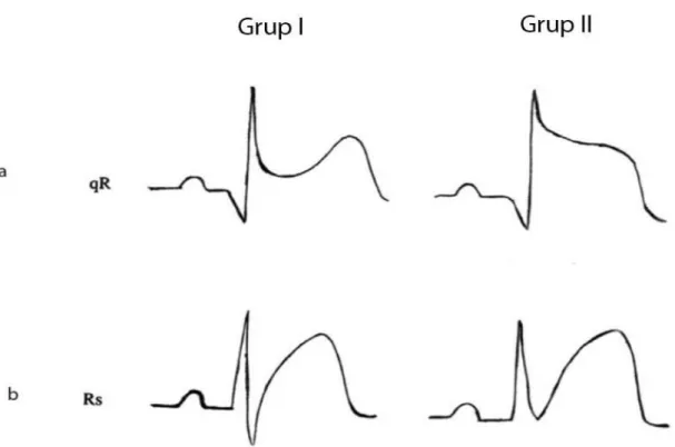 Şekil 7: Terminal QRS distorsiyonu paternleri 