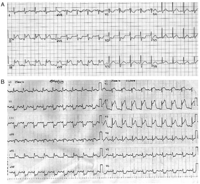 Şekil 8: Terminal QRS distorsiyonu örneği – 1 