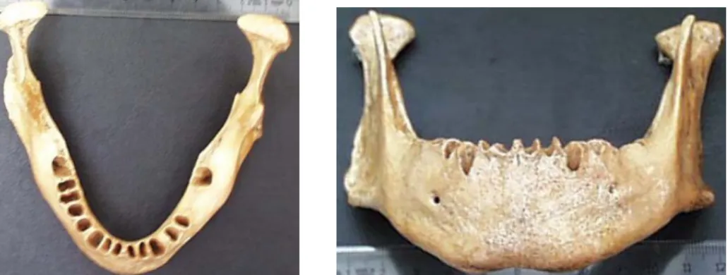 Şekil 1. İnsan mandibulasının üstten ve önden görünüşü. 