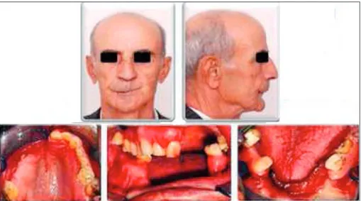 FIGURE 1: Extraoral and intraoral view of the Patient 1 before the treatment.