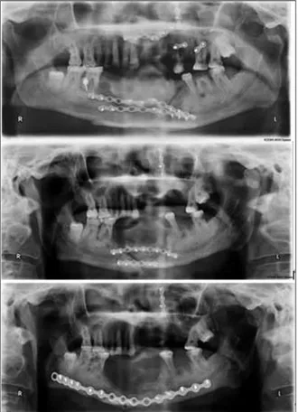 FIGURE 2: Panoramic radiographs showing mini plates and screws used for fixing fractured maxilla and mandibula for Patient 1.