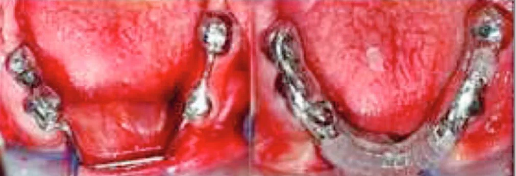 FIGURE 3: Trial evaluation of  the bar and framework for Patient 1.