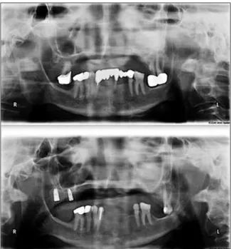 FIGURE 7: Trial of implant supported removable partial denture framework for Patient 2.