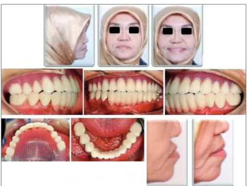 FIGURE 8: Final restorations of Patient 2. Acrylic resin was used to compansate for the loss of hard and soft tissue and lip support.