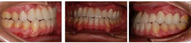 Fig.  4.  View  of  the  patient  before  the  treatment  and  distraction  phase 