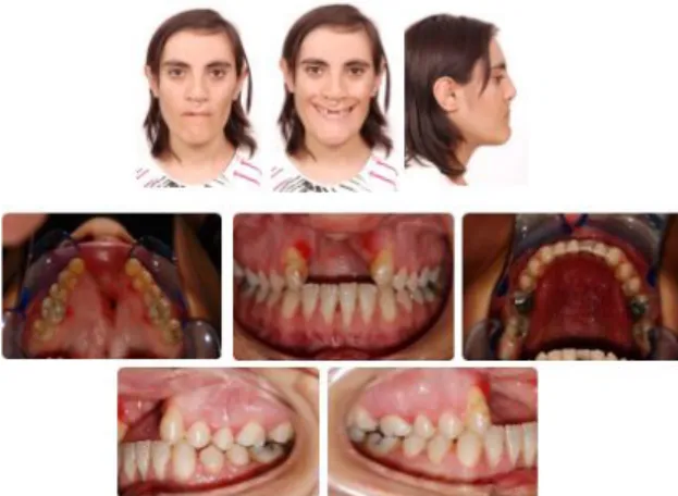 Fig. 5. After distraction osteogenesis and orthodontic treatment 