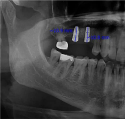 Table 1. The relationship between the actual size of the implants  and the measured size on the PRI of the implants according to the  regions (M ±SD)