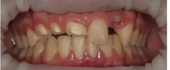Figure 2. Coronal post and laminate preparations