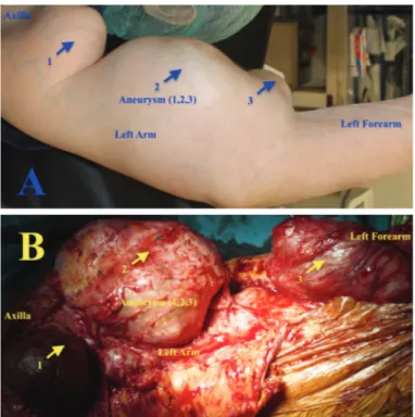 Figure 1. Preoperative view of the left arm (A) and intraoperative  view of the aneurysmal exploration (B)